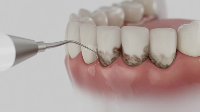 Reliable Dental Implants contractor in Canton, MO by Smile Center Dentistry